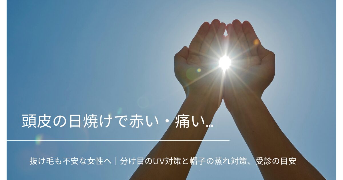 青空の下で手で日差しを遮る写真に「頭皮の日焼けで赤い・痛い…」の文字を載せたアイキャッチ画像（頭皮の日焼け・抜け毛不安、分け目のUV対策と帽子の蒸れ対策、受診の目安）
